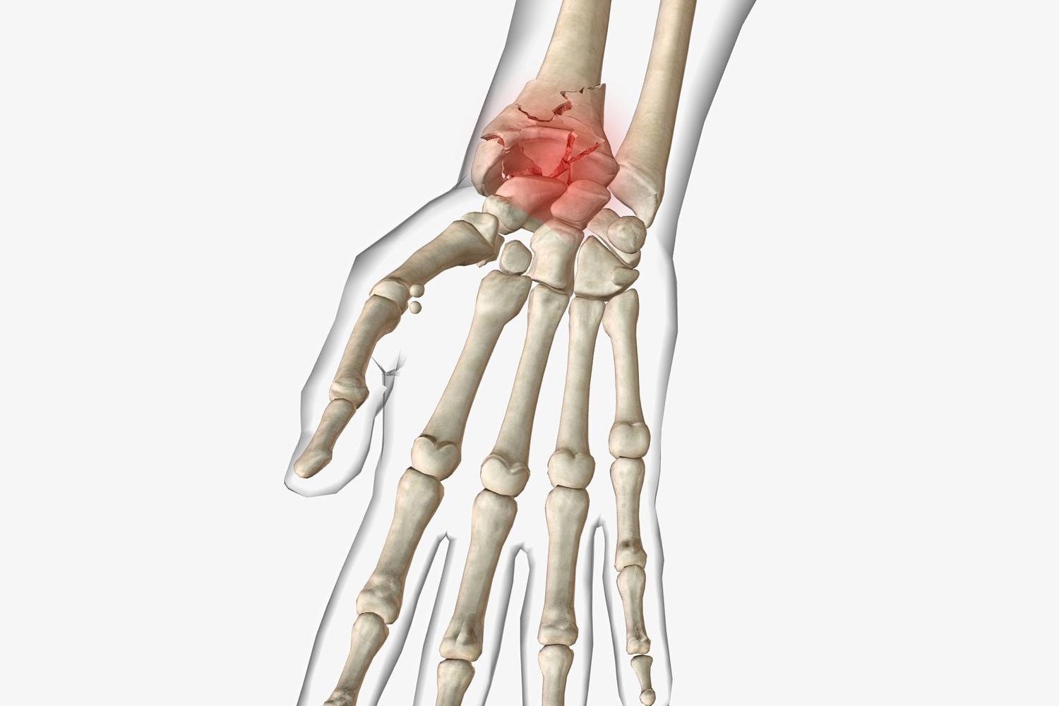 Handgelenksbruch